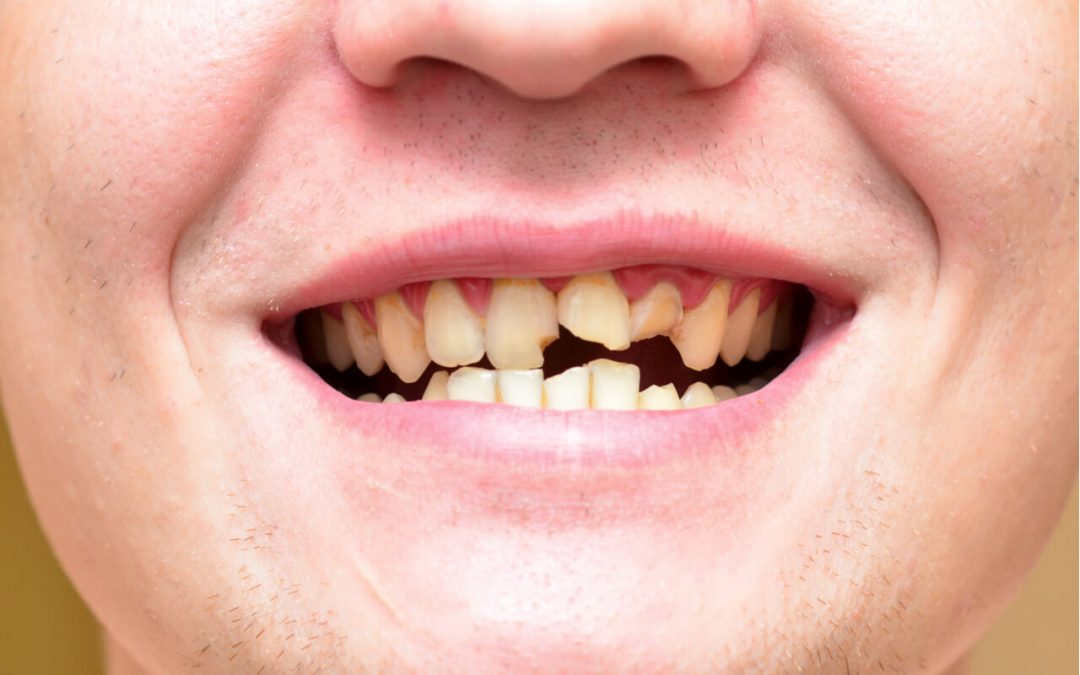 Dental Trauma: What Can I Do If I Have A Broken Tooth?