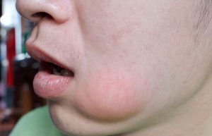 signs of gum disease abscess