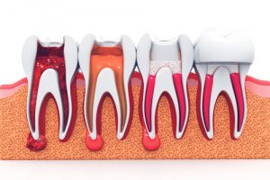 signs of gum disease stages