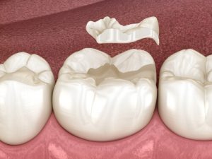 endodontic surgery root surface