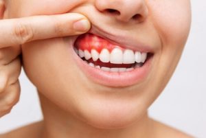 how long does a root canal last without a crown abscess