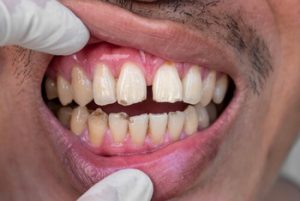 how long does a root canal last without a crown signs